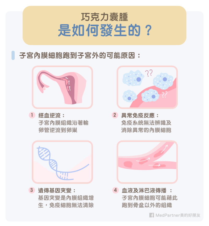 巧克力囊腫成因