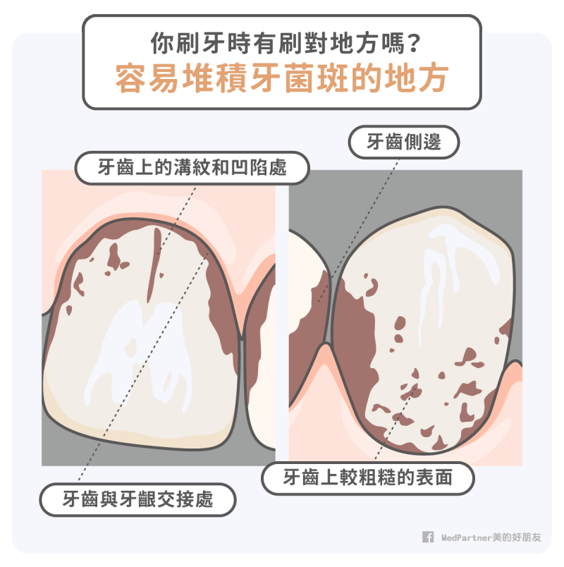 牙菌斑堆積處