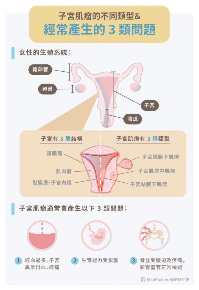 不同的子宮肌瘤類型與其症狀