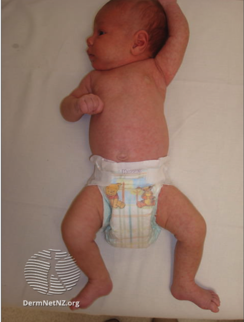 玫瑰疹。在臉部、軀幹以及四肢都長了玫瑰色紅斑的嬰幼兒。DermaNetNZ.org CC BY-NC-ND 3.0 NZ
