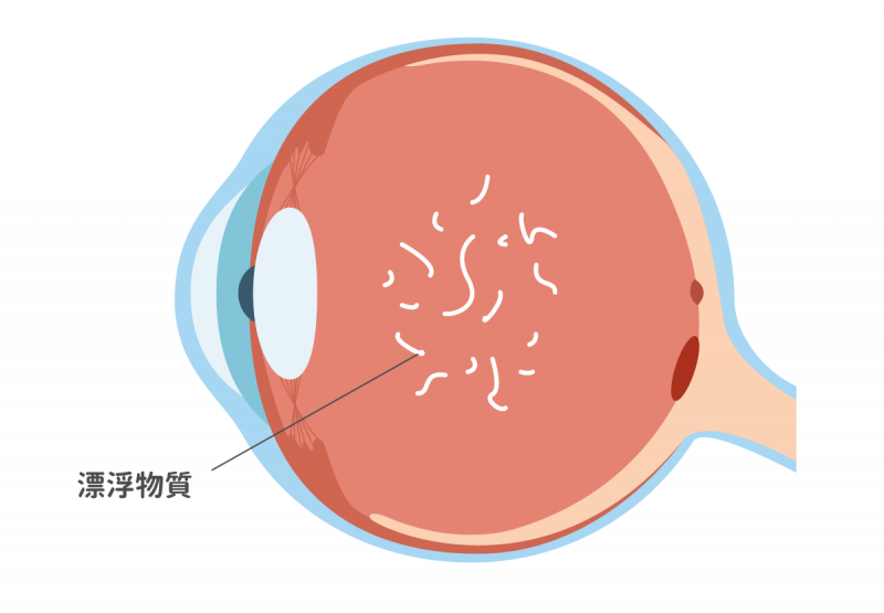 飛蚊症病變時眼部的構造變化