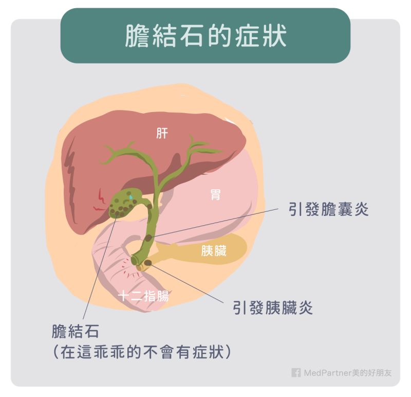 膽結石的症狀